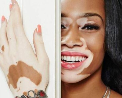 Winnie Harlow