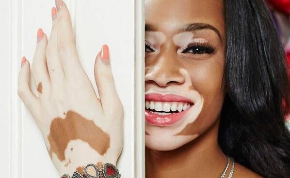 Winnie Harlow